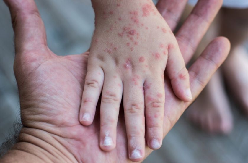 Más de 120 casos de sarampión en el país: autoridades insisten en vacunación y medidas de bioseguridad