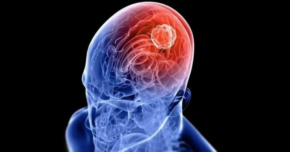 Científicos crean células capaces de atacar uno de los tumores cerebrales más letales